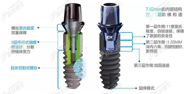 德国icx种植体设计