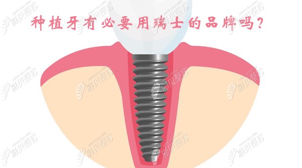 种牙有必要用瑞士的吗