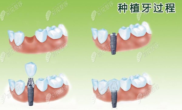 种植牙过程和步骤