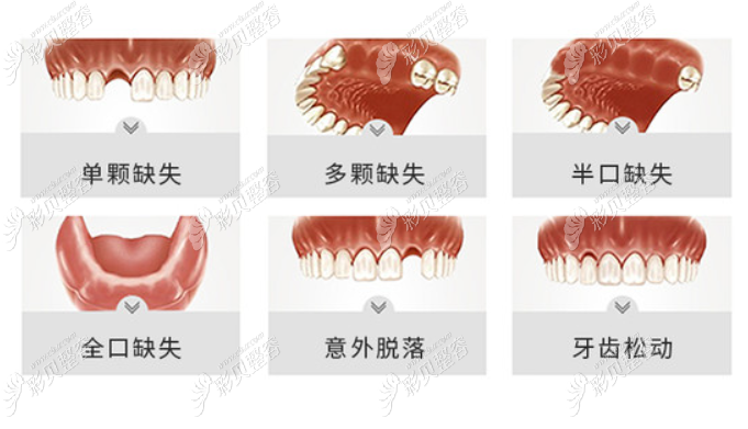 种植牙适合解决哪些口腔问题