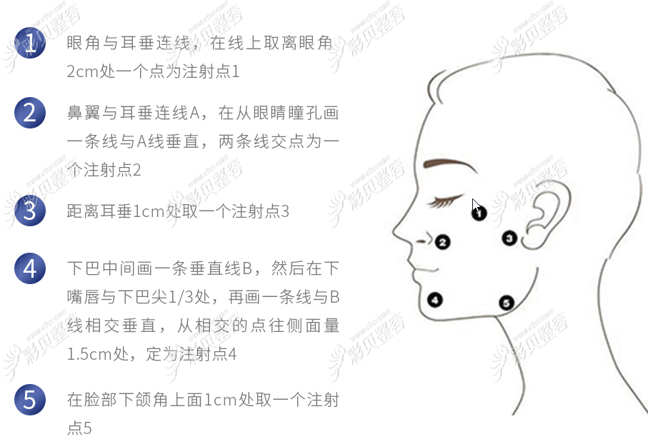 面部提升针注射点位图片