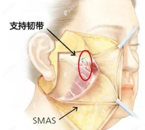 筋膜悬吊术作用层次示意图