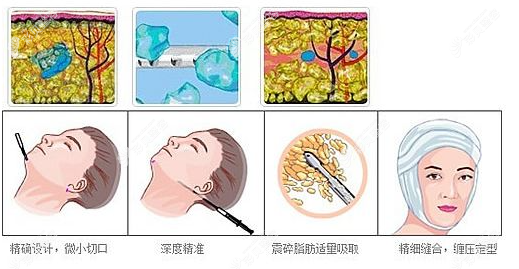 面部吸脂过程图片