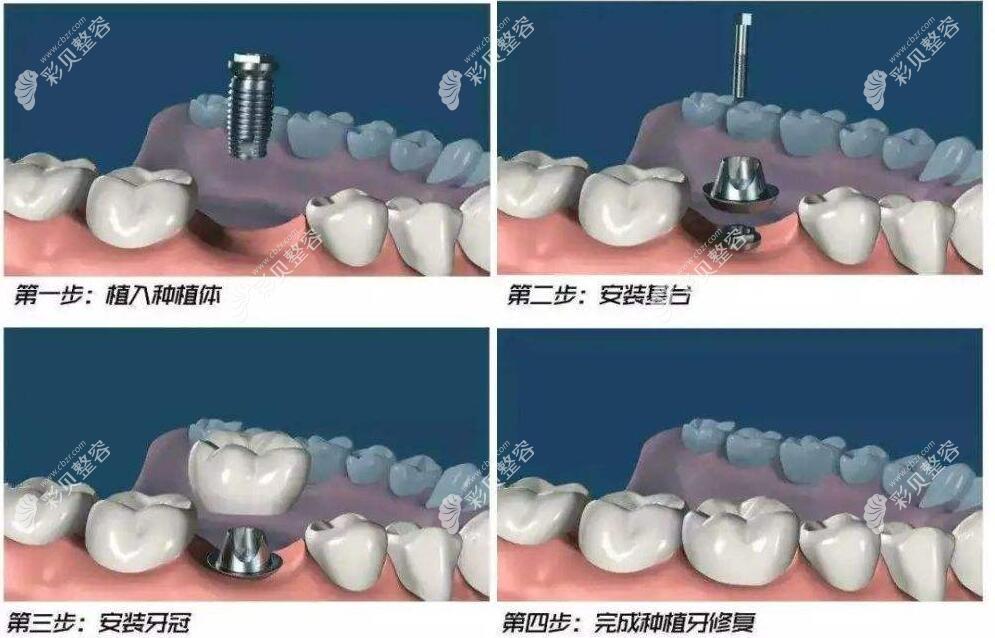 牙医说种植牙一期二期是什么意思是否可以一起做看区别