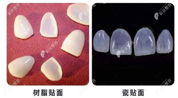 树脂牙贴面和瓷贴片的区别