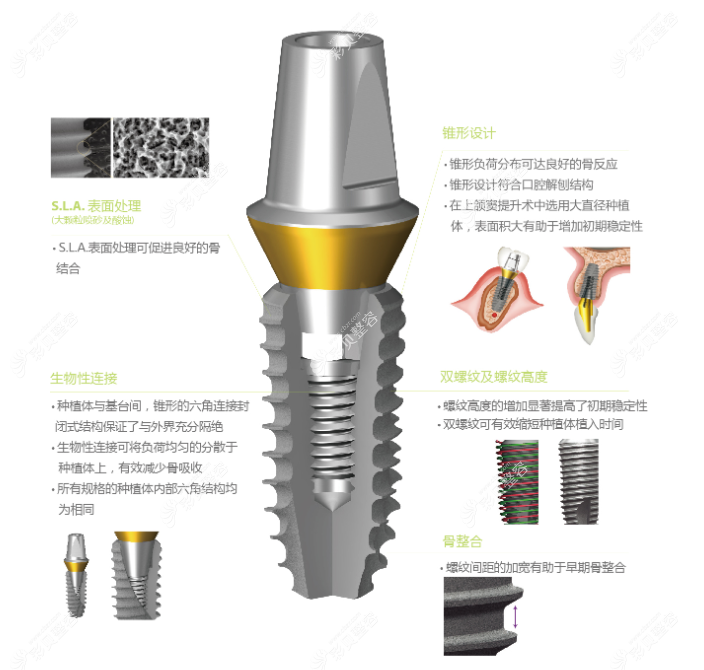 登腾superline种植体怎么样