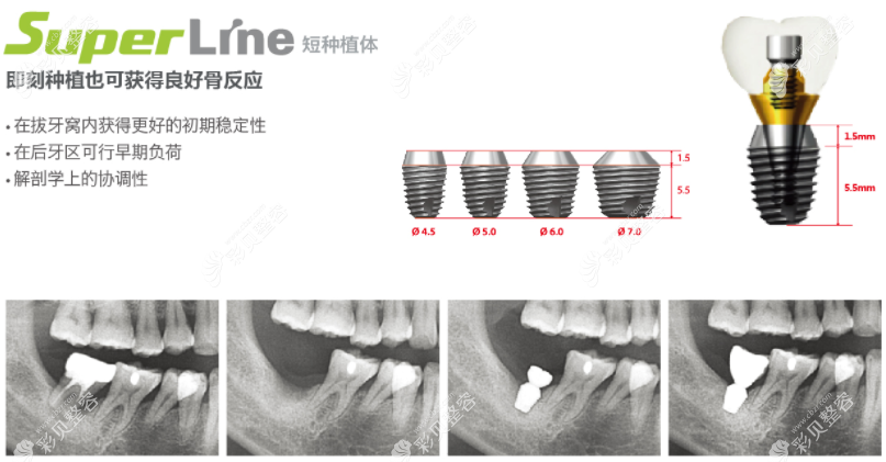 韩国登腾superline种植牙好不好