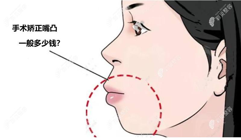 凸嘴手术整容多少钱图片