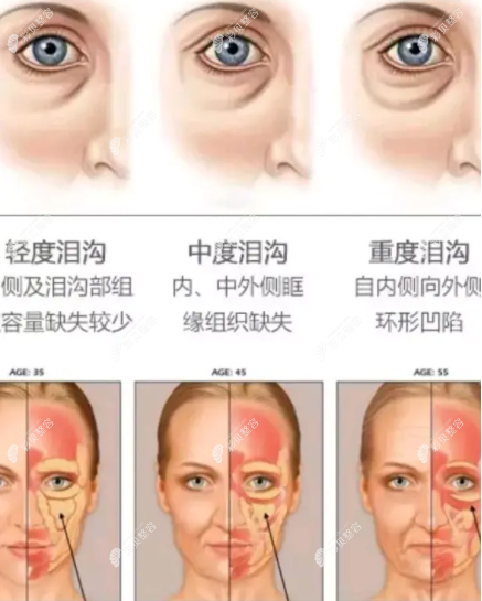 泪窝面相分析图片