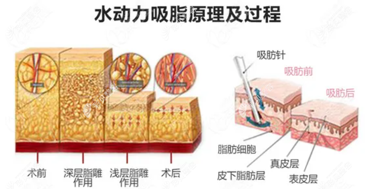 从黄金微雕和水动力吸脂的区别来看哪个更适合大腿吸脂