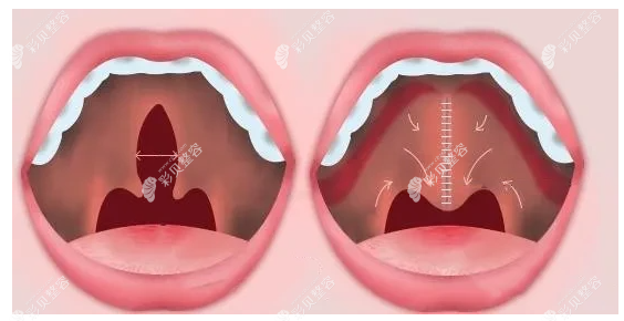 先天性唇腭裂手术免费吗