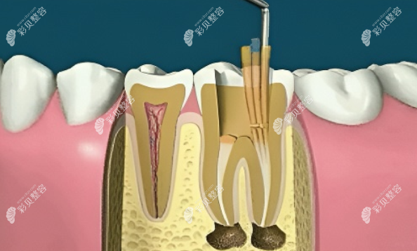 根管治疗详细步骤图解用8张图了解根管充填的目的是什么