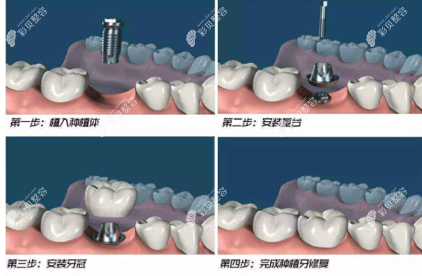 种植牙的过程和步骤