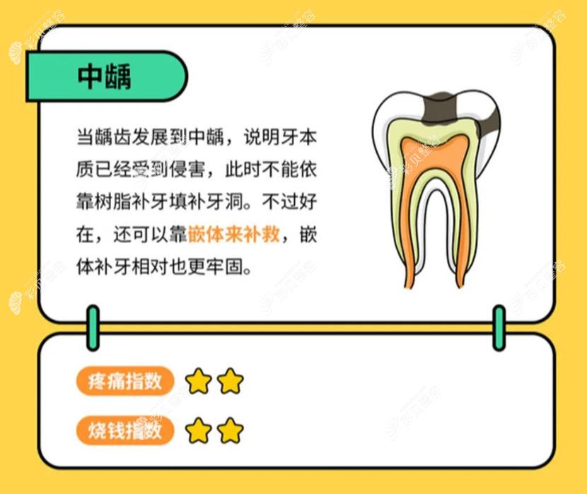 1,牙齒深齲一定要做根管治療深齲的症狀是牙齒上黑點面積比較大,且