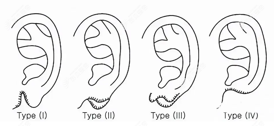 耳垂畸形主要表现为:耳垂过大过长,耳垂尖粘连,耳垂裂等症状.