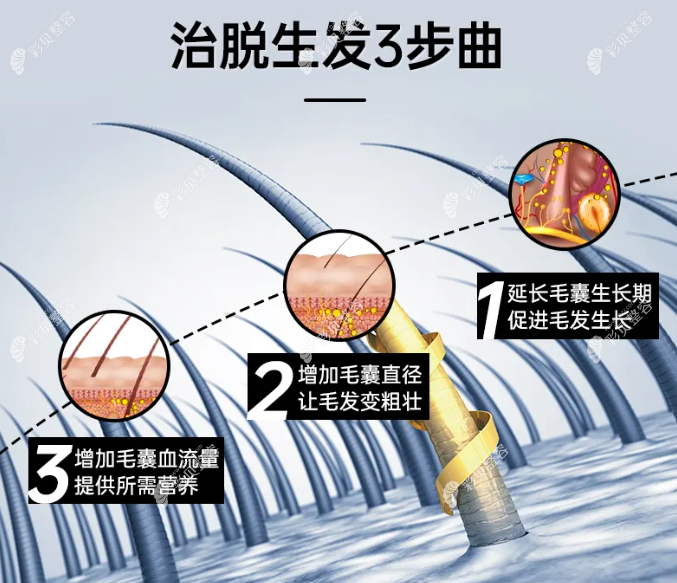 米诺地尔治疗脱发3步曲