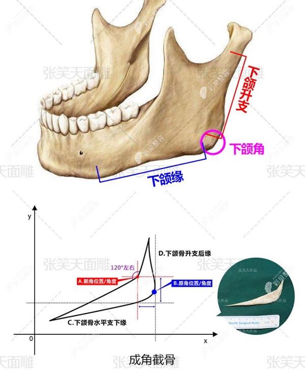 北京圣嘉新医院张笑天做下颌角磨怎么样